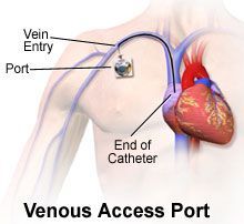 Totally Implantable Access Port Market Report 2021-2028