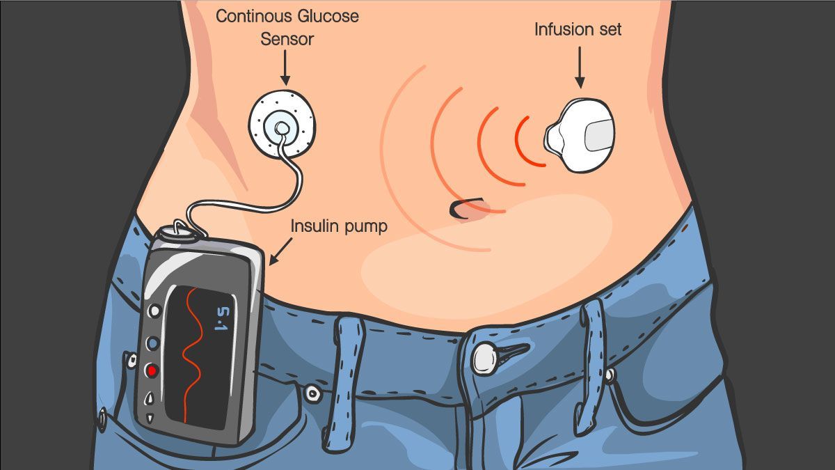 Tubeless Insulin Pump Market Players Analysis Report Till 2028
