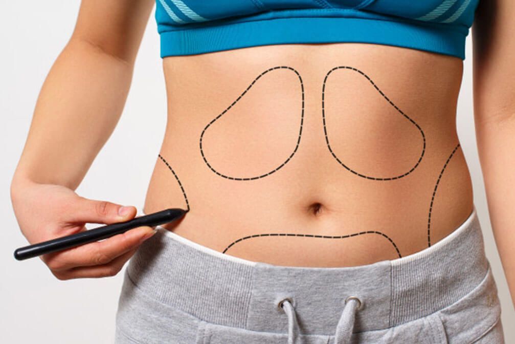 Pros of Liposuction and Tummy Tuck Surgeries