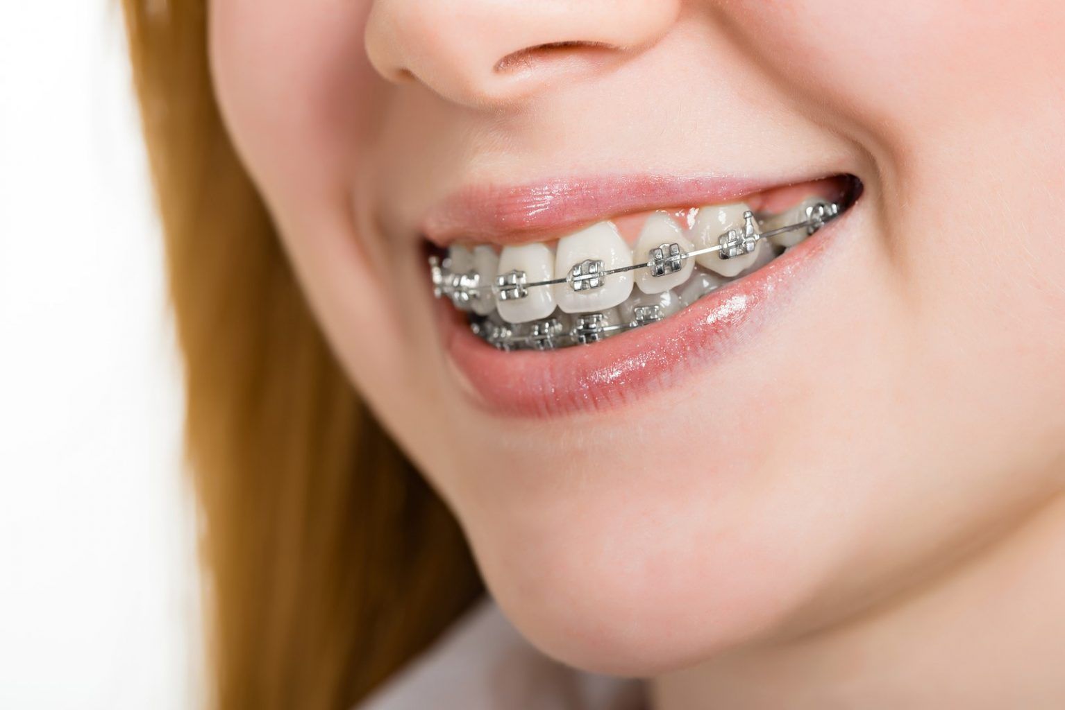How Long Will I Wear Braces? Understanding Treatment Duration
