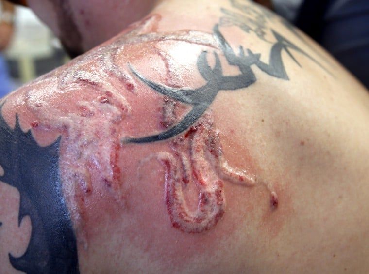 Understanding the Signs of Injury After Laser Tattoo Removal