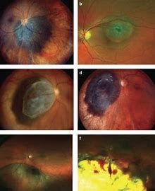 Uveal Melanoma Treatment Market Report | Value Market Research