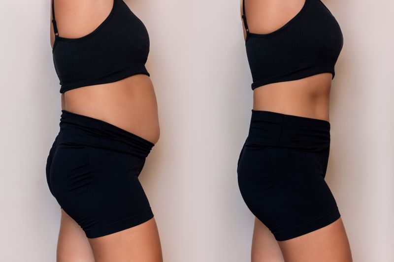 Top 5 Clinics for Vaser 4D Liposuction in Dubai
