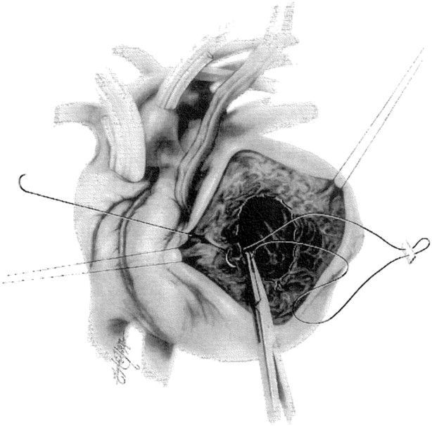 Ventricular Restoration Systems Market – Exclusive Reports