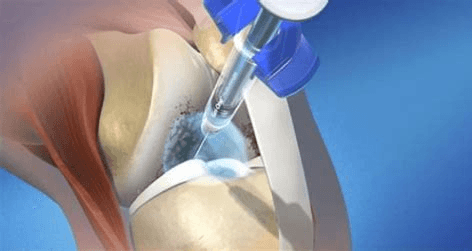 Viscosupplementation Market Size, Trends Report to 2028