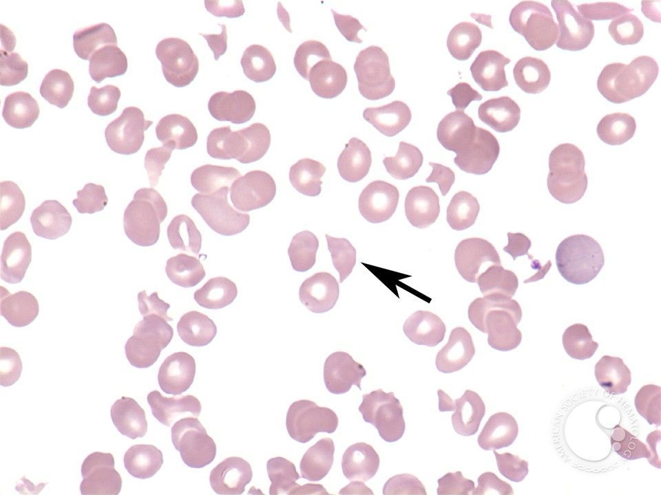 Warm Autoimmune Hemolytic Anemia Market | Growth & Trends 