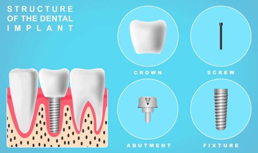 Why Dental Implants Are a Smart Investment