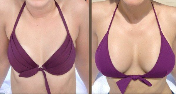Breast Augmentation in Turkey: A Complete Guide to Breast Enlargement in Istanbul