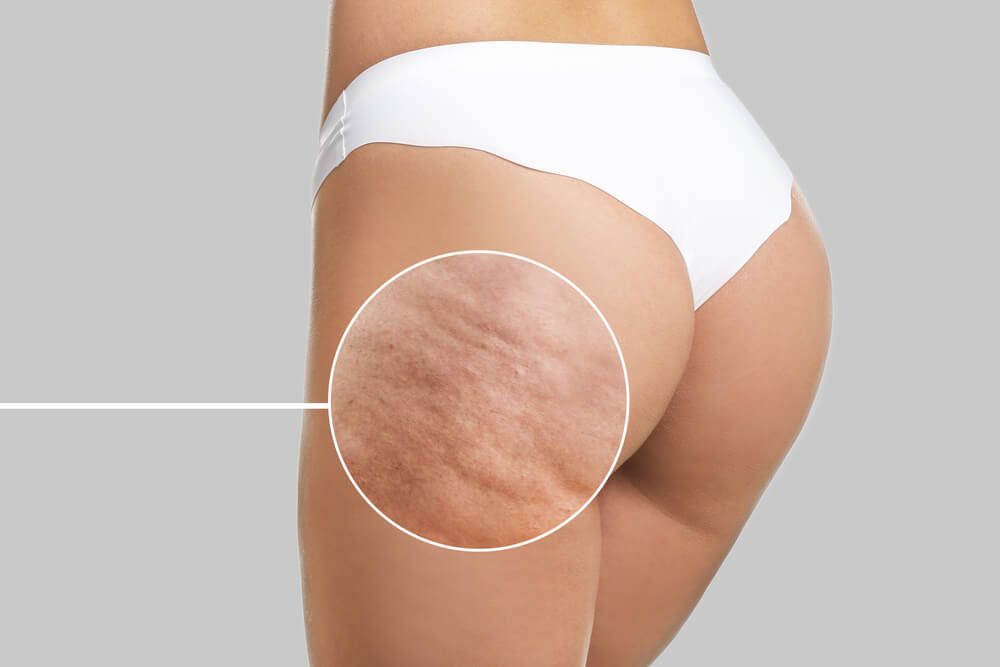Do Probiotics Help Cellulite?