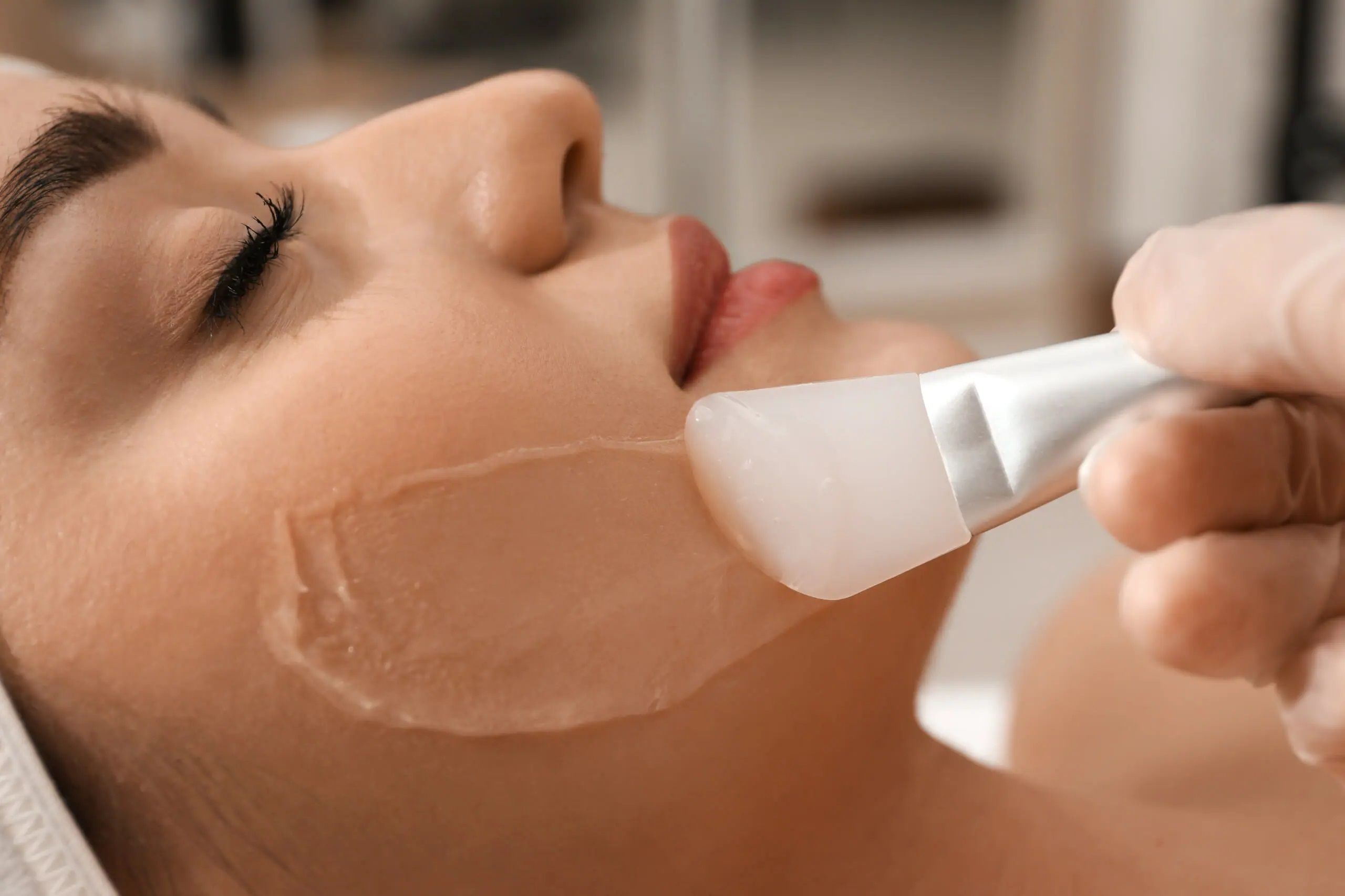 How many sessions of chemical peel are needed?