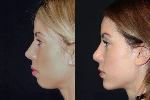 Best Plastic Surgeon in dubai for Chin Fillers: Top Techniques for a Defined Look