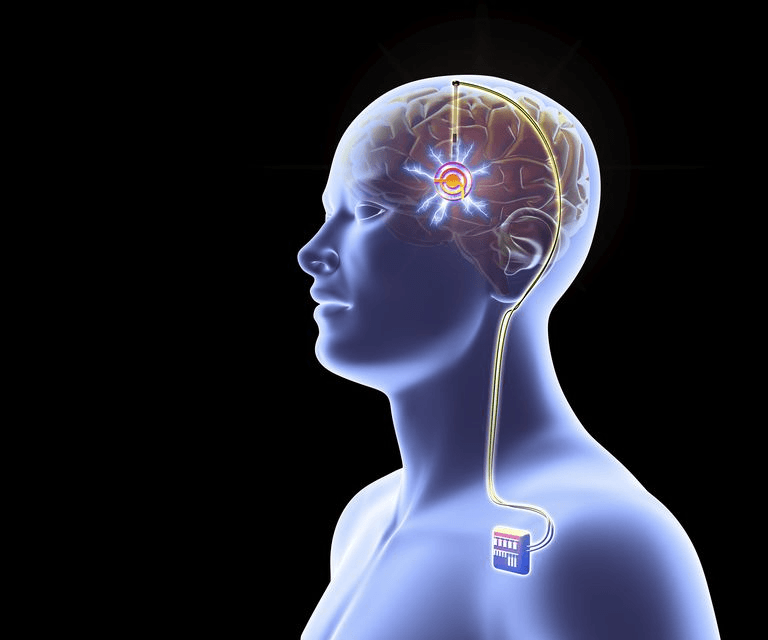 Deep Brain Stimulation Devices Market Us$ 3033.4 Million by 2030