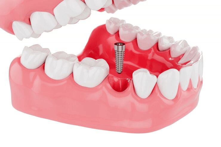 Get Procedure of Dental Implants for Good Health, Explained