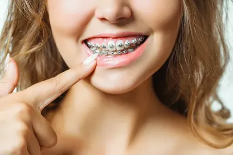 Fixed vs. Removable Dental Braces in Islamabad: Which Works Best?