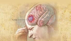 Latest Treatment Options for Glioblastoma Cancer in India (2025 Update)