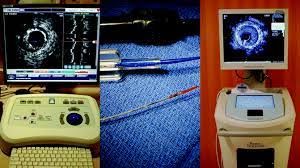 Intravascular Ultrasound Tools Market Significant Growth by 2030