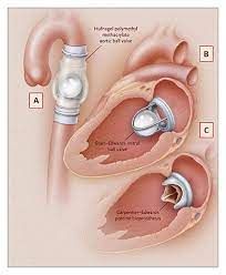 Artificial Cardiac Valves Market Growing at a Cagr of 13.8% ,2030