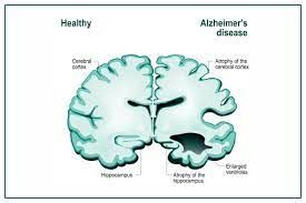 Supporting Caregivers of Individuals With Dementia and Alzheimer'