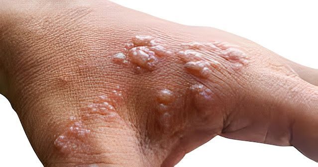 Interesting Facts About Monkeypox - This Will Surprise You