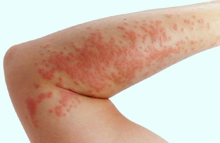 8 Essential Oils for Rashes