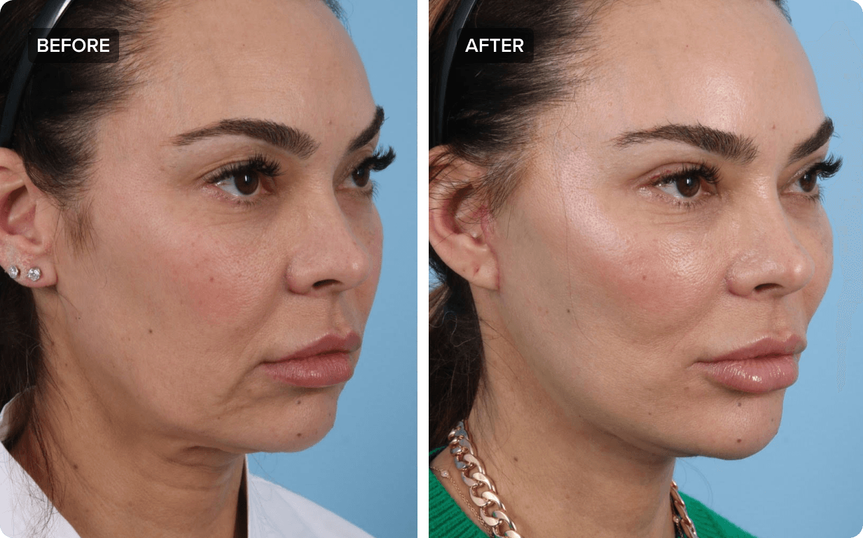 How Face Lifts in San Francisco Can Enhance Your Natural Beauty