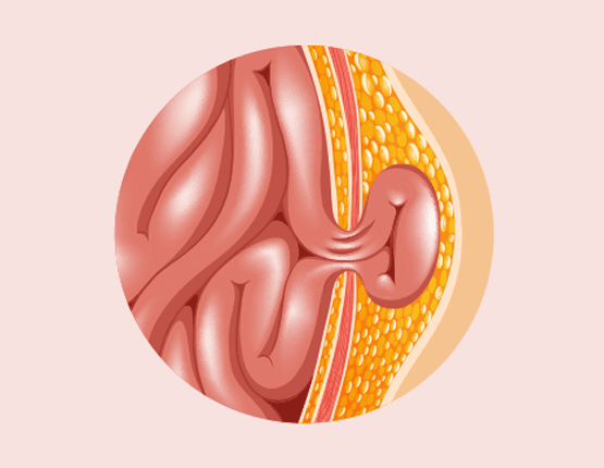  Treatment for Abdominal Hernia