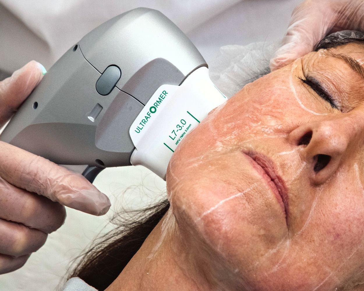 Long-Term Effects of HIFU Treatment on Skin Structure?