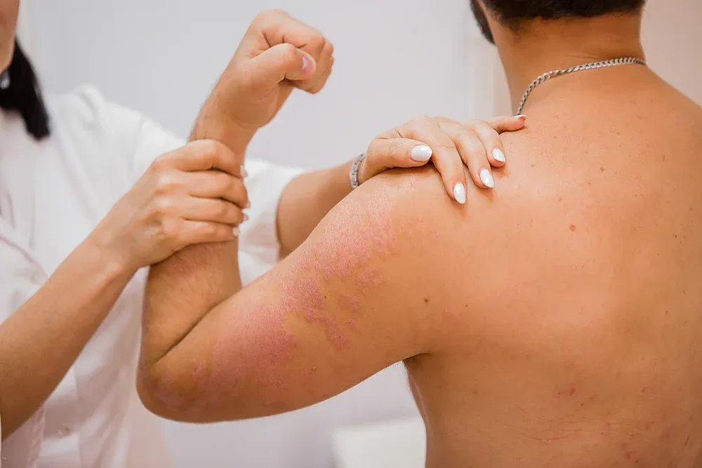 Can Stress Cause Hives? Best Stress-Related Hives Treatment in Islamabad Explained