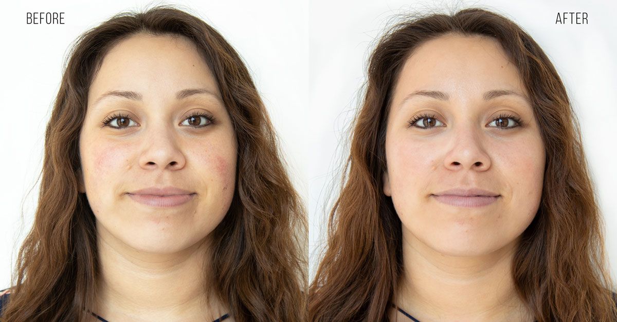 Which Scottsdale HydraFacial Treatment Is Right for Your Skin Concerns?
