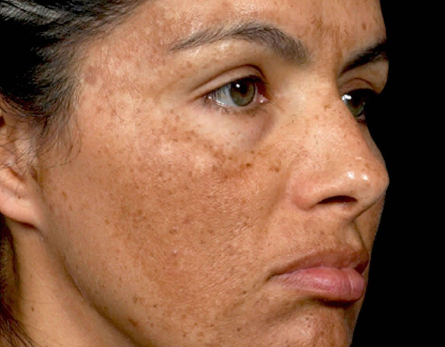 Can hyperpigmentation happen anywhere on the body?