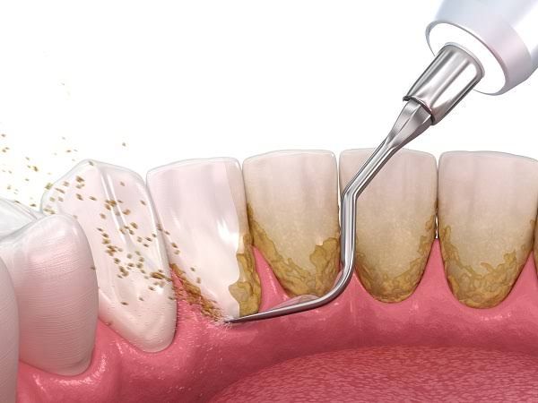 What Is the Importance of Dental Cleanings?
