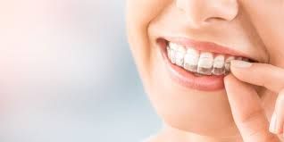 What Are the Benefits of Invisalign Treatment in Houston, Tx?