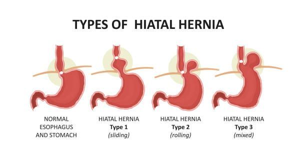 Causes of Abdominal Hernia in Paeds and Adults