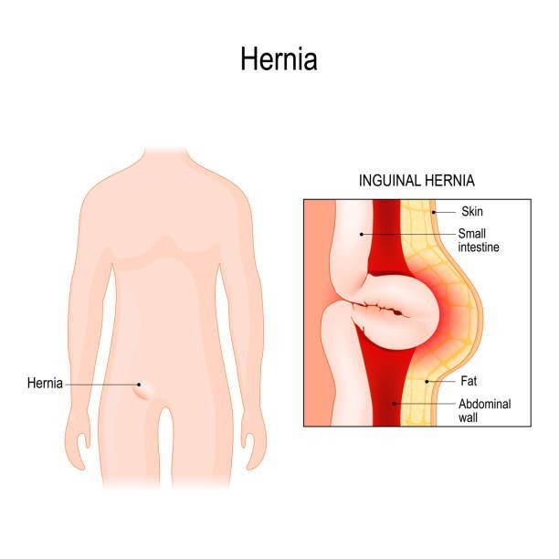 What Is the Severity of an Abdominal Hernia?