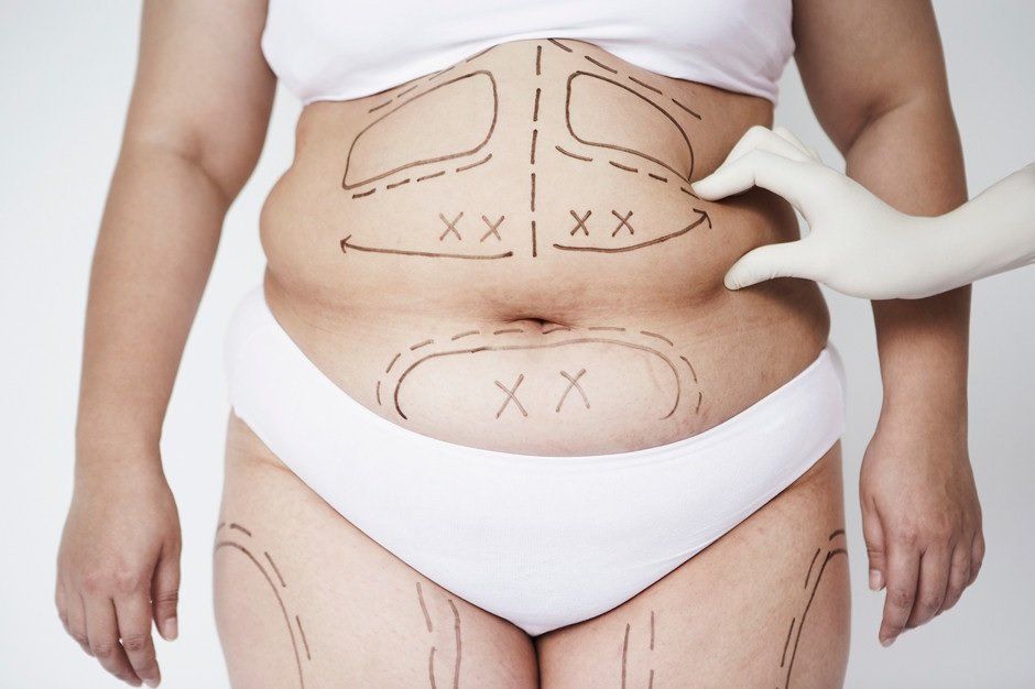 Liposuction in Islamabad: Is It Safe?