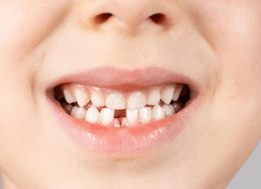 Missing Teeth: Real Solutions That Restore Your Smile and Your Confidence