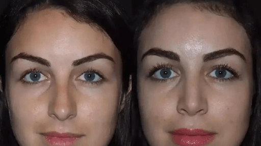 Expert Advice from the Best Septoplasty Surgeon in Dubai