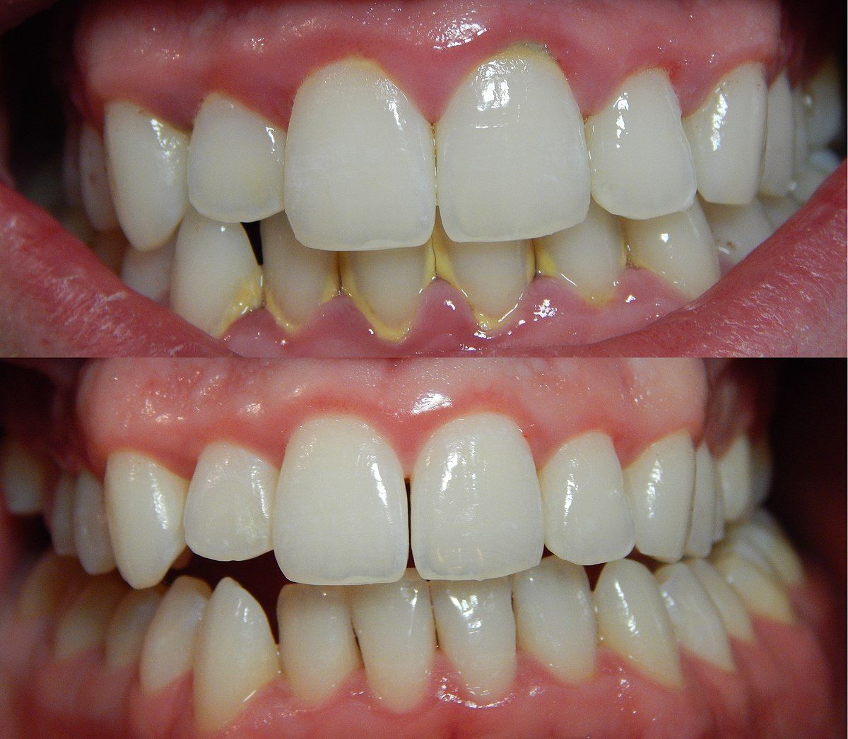 Can scaling remove cavities?