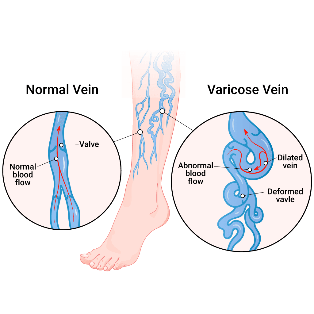 Best Varicose Veins Treatment in Lucknow: Safe & Advanced Care