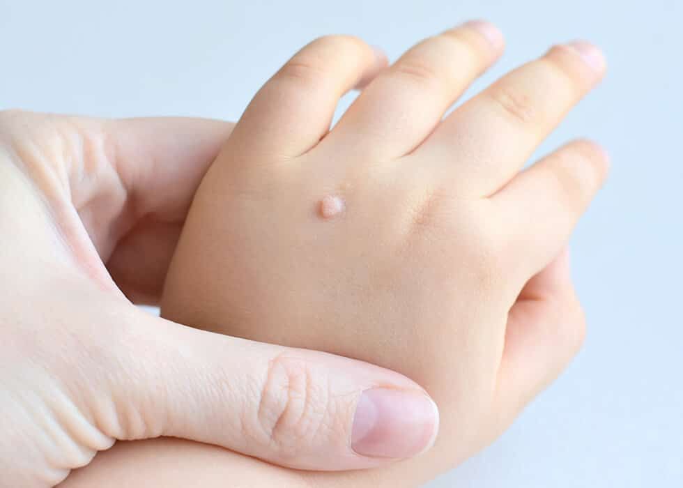What Patients Ask About Skin Wart Removal Cost in Dubai?