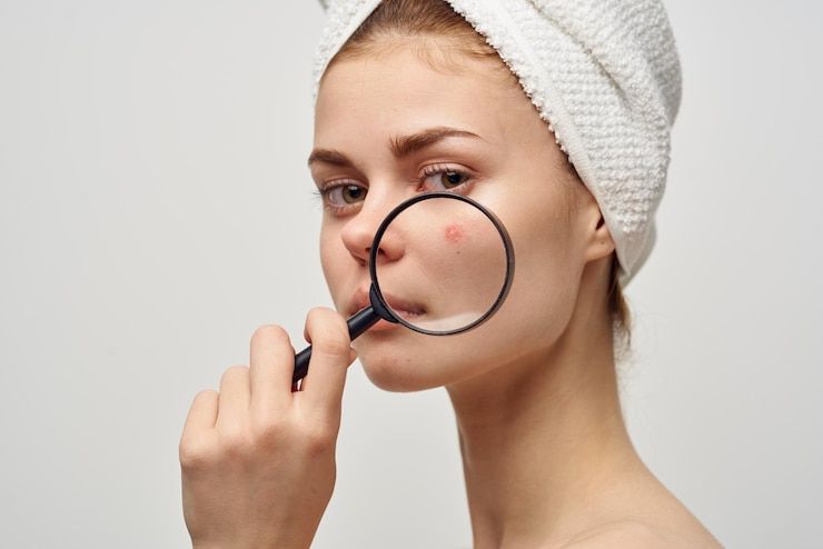 Can pimple treatment prevent future breakouts?